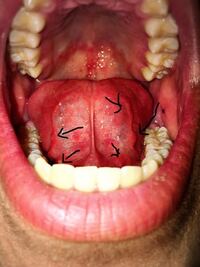 毎日唇の裏に白い膜 みたいなものができます 触った感じ剥がせ Yahoo 知恵袋
