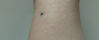 気づいたら足首にほくろができていました 黒くて他のほくろとは明 Yahoo 知恵袋