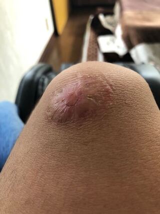 キズパワーパッド 抜糸 後