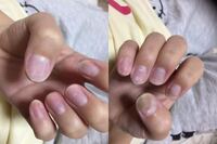 閲覧注意至急回答お願いしたいです 助けてくださいー自分でスカルプのネイル Yahoo 知恵袋