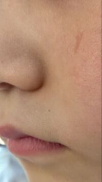 5歳の子供の左頬の傷跡が消えません 半年くらい前に傷ができたみたい Yahoo 知恵袋