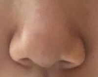 鼻の整形をした方に質問です 5日前に鼻尖縮小の手術をしました 鼻先を Yahoo 知恵袋