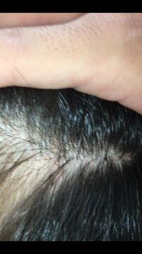 頭 白いかさぶた アンテベート 知恵袋