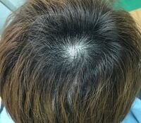 昔からつむじが広いのですが これはやばいですか Yahoo 知恵袋