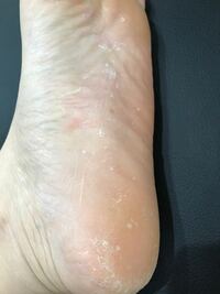 注 足の裏の画像あります 片足だけこのようにだいぶ前から 皮が剥 Yahoo 知恵袋