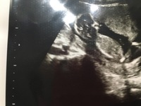 15週のエコーなんですがやっぱこれだと女の子か男の子かわからな Yahoo 知恵袋