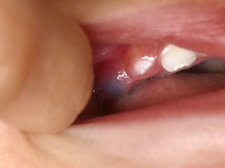 に 血豆 歯茎 こんな歯茎の水ぶくれは危険！誰でもわかる歯茎の水ぶくれ・水疱・できもの診断