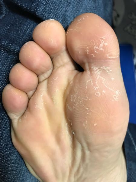 水虫 解決済みの質問 Yahoo 知恵袋