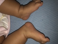 生後2ヶ月の赤ちゃんの足首のしわが左右非対称なのですがこれは脱臼でしょう Yahoo 知恵袋