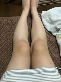 至急 明日ミニスカートを履くつもりだったんですけど足を怪我し Yahoo 知恵袋