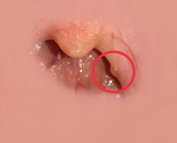 喉ちんこの横に水泡のようなものができていて つばを飲み込むと違和感と Yahoo 知恵袋