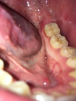 これは虫歯ですか 奥歯の根元の歯茎に赤い点のような部分があり Yahoo 知恵袋