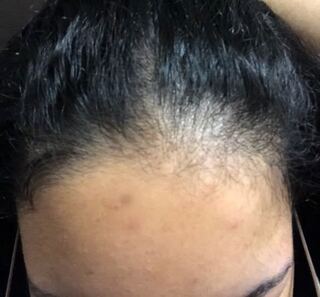 閲覧注意 昔から前髪が長いので髪を全部後ろにまとめる髪型をしていたらこ Yahoo 知恵袋