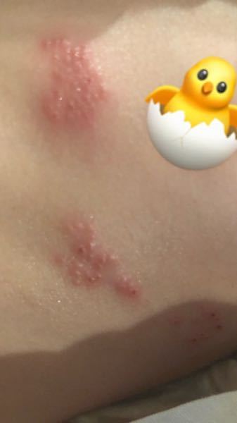 皮膚の病気 アトピー 解決済みの質問 Yahoo 知恵袋