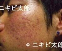 頬全体にニキビ跡があり凹んでいるように見えます このような感じです Yahoo 知恵袋