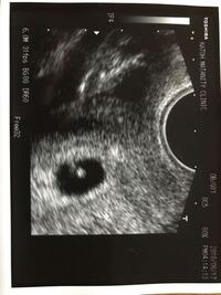 このエコー写真に写っているものは胎児ですか 妊娠5週0日目のエ Yahoo 知恵袋