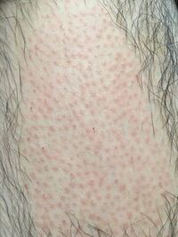 閲覧注意 お見苦しい写真すみません 昨日初めてviｏをブラジリアンワ Yahoo 知恵袋