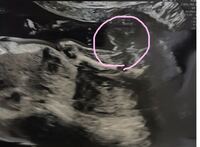 17wの健診で 突起物もなく 割れ目があるので暫定女の子と言われました Yahoo 知恵袋