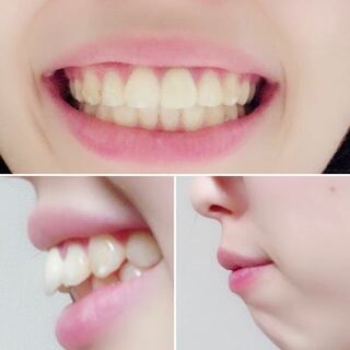 口ゴボ 前歯の出っ歯について 抜歯なしの歯列矯正を小6 Yahoo 知恵袋
