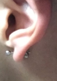 軟骨にピアスを開けたのですが軟骨部分が白い皮の様なものが出来て後ろがプクッ Yahoo 知恵袋