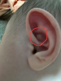 赤ちゃんの耳のできもの について 生後二ヶ月の赤ちゃんの左耳に丸い でき Yahoo 知恵袋