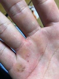 手のひらにタコのようなものが出来ました 以前も同じところにでき 白 Yahoo 知恵袋