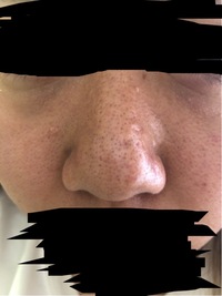 閲覧注意 オイリー肌で毛穴が汚すぎます 22歳女です22年間色 Yahoo 知恵袋