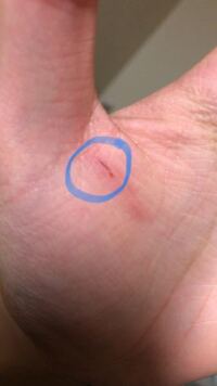 左手に髪の毛 長さ5ミリくらい が刺さっています 限りなく皮膚の表面に近 Yahoo 知恵袋