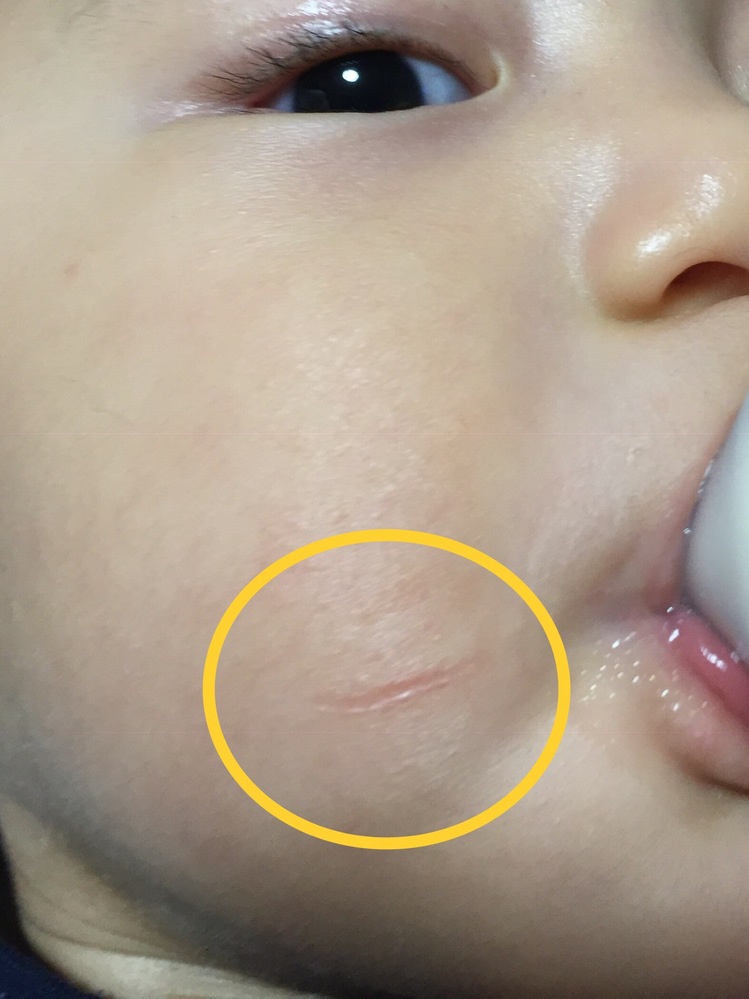 赤ちゃんの顔の引っかき傷こんにちは 息子の顔にある傷のことで相 Yahoo 知恵袋