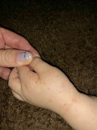 １歳２ヶ月の子供の左手に内出血のような赤い斑点がポツポツとあります Yahoo 知恵袋