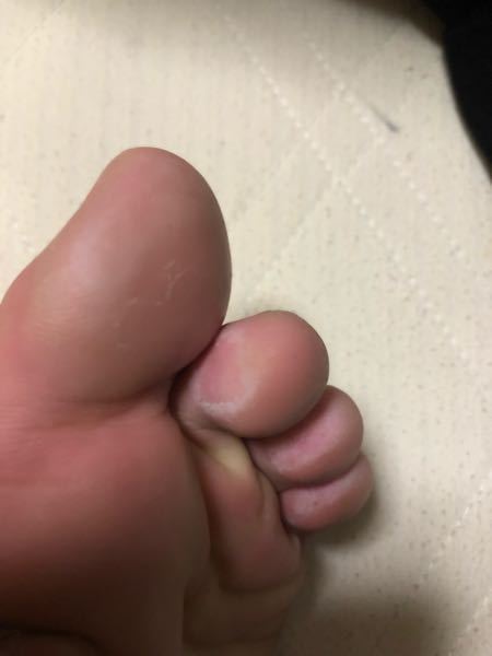 足 の 親指 皮 が むける