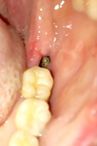 膿 親知らず 抜歯 歯茎からの膿を止めたい方必見！膿が出る原因と治療法