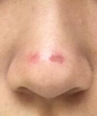 鼻にあったニキビを潰しました 赤いのですが 凹んでないし痛くありません Yahoo 知恵袋