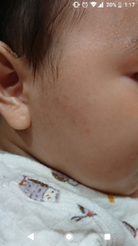 アレルギー 赤ちゃん 症状 卵 卵アレルギーの症状は？赤ちゃんへの卵アレルギー予防とは？
