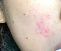 ここ最近 ほうれい線のあたりにこんな赤い湿疹ができます 痒みはありません Yahoo 知恵袋