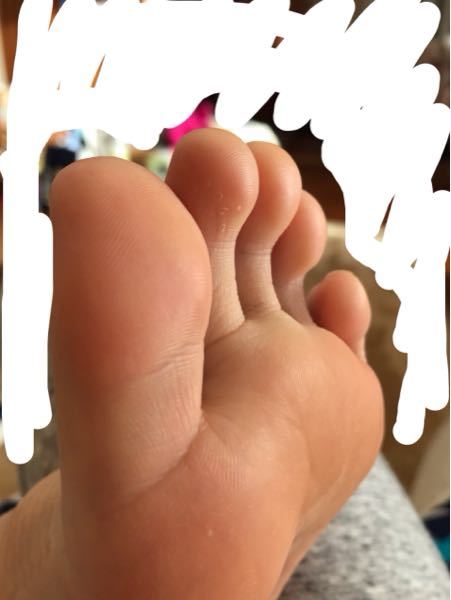 水虫 解決済みの質問 Yahoo 知恵袋