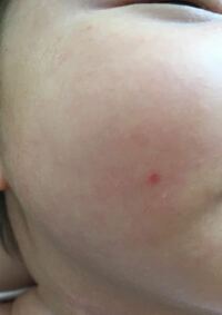10ヶ月の赤ちゃんの耳にこのような赤い発疹が出来ました 手にも1つあります そ Yahoo 知恵袋