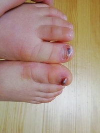 足の爪が縦に割れると二度とくっつかないと言われたのですが 本当なの Yahoo 知恵袋