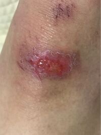 膝を怪我してから6日経ちました ぜんぜん治らないんです どうすればいいで Yahoo 知恵袋