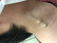 6歳の息子 頚部 首の静脈に瘤らしきものが 小児科にみてもらったけど回答 Yahoo 知恵袋