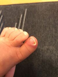 2歳になる娘の足の親指が 化膿したように白くなり 赤く腫れ上がっています Yahoo 知恵袋