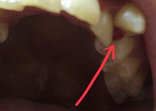 画像閲覧注意 八重歯の裏の歯茎が腫れています 写真のように 八重歯 Yahoo 知恵袋