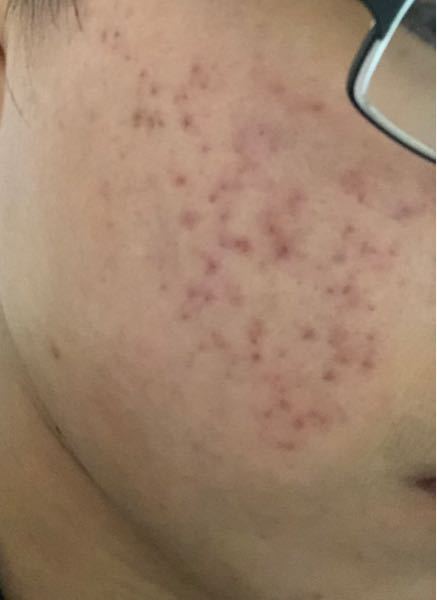 汚い画像失礼します 夏場からニキビができてしまい秋ぐらいからニキビ跡に Yahoo 知恵袋