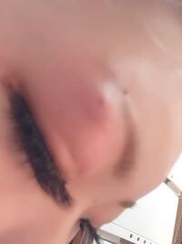 右眉の眉間付近にコリコリしたしこりがあり虫に刺されたかのように腫れてい Yahoo 知恵袋