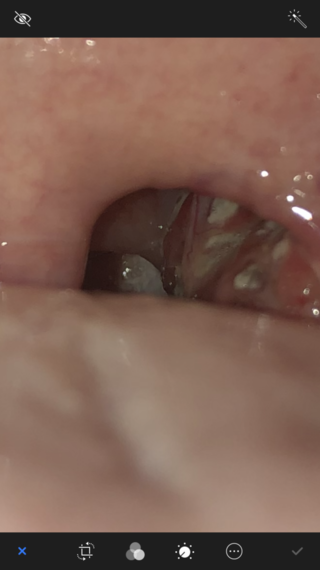 これって喉のクラミジアですか 白い部分は膿栓と思います 俗に言う臭 Yahoo 知恵袋