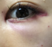 目の下の脂肪注入をしたらしこりができました 目の下の脂 Yahoo 知恵袋