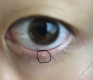 目 の ふち に 白い でき もの 黒目にかかる薄く白い影 翼状片とは 目の病気 All About