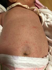 生後8ヶ月の赤ちゃんが1ヶ月前から胸とお腹にポツポツと湿疹が Yahoo 知恵袋