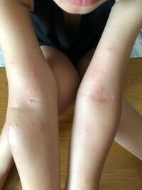 水ぼうそう 水痘 は２回目はありますか 大人でもうつりますか 水疱瘡 Yahoo 知恵袋