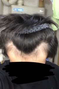 高校二年生の生え際です 昔から髪が細くサラサラではあったのですが 生え際 Yahoo 知恵袋